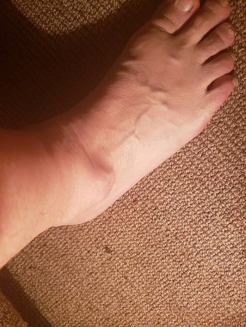 a sprained ankle